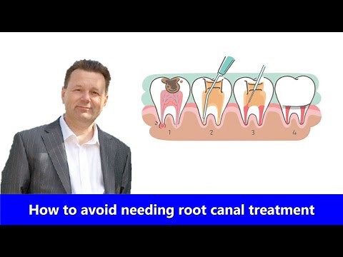 How to avoid needing root canal treatment & tips for healthy teeth
