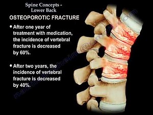 Low Back pain, causes, diagnosis and treatment.
