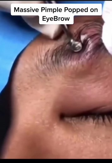 Part two !! 😎🤤😱 #pimplepop #blackhead #pimple #satisfying #pimpleremover #pimpleaddiction #pimplepopper2023 #pimpleaddiction #fyp #fypシ #pourtoi #foryou #foryoupage #beautytok #moovie #peeling #dermaplaning #acne #part2