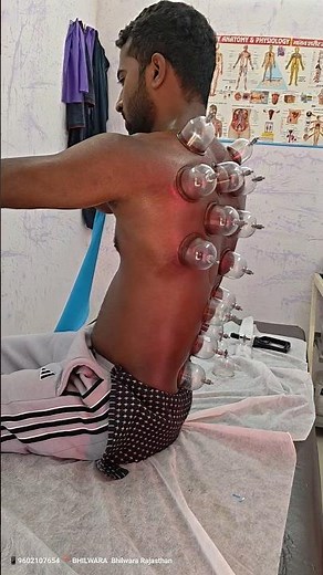 💥 Shoulder Blade (Scapula) Pain Relief Treatment|Cupping Therapy| Therbenend Exercise|#shorts #gym