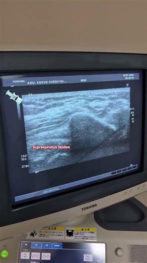 Ultrasound guided subacromial-subdeltoid injection