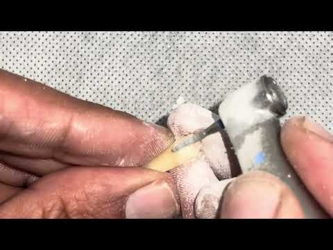 Wing Preparation for Porcelain-Fused-to-Metal (PFM) Crown on Upper Premolar #25 #15
