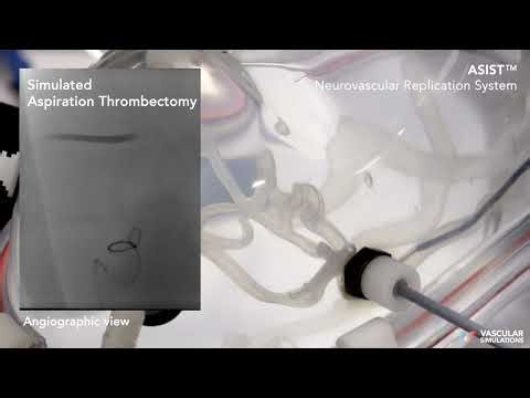 ASPIRATION THROMBECTOMY - Simulated with ASIST