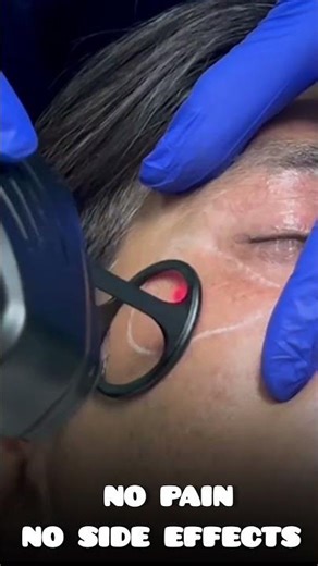 Laser Treatment for Wrinkles | Get Younger Skin Instantly | Anti-Aging Solution 2026