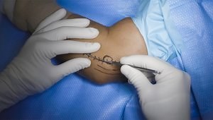 UCL Repair with Suture Tape Augmentation and Flexor Pronator Repair