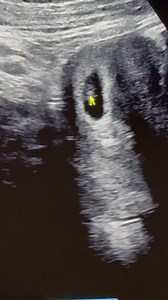 September 2nd cannot come faster🤍🩷🩵👶🏻 #heartbeat #pregnant2024 #ultrasound | Drue Basham