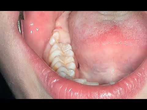fast lower wisdom tooth extraction