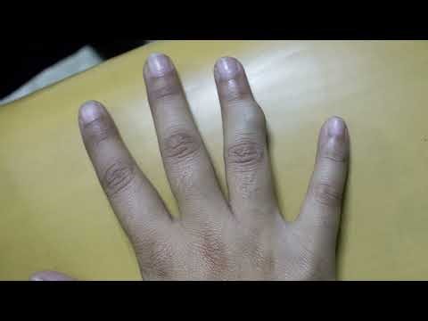 Chondroma, Enchondroma and Osteochondroma: symptoms and treatment. Benign cartilage tumor