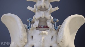 L5-S1 Posterior Lumbar Interbody Fusion Animation