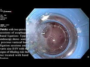 Esophageal varices band ligation