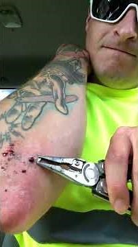 Newest pimple removal 2022 - Cystic acne extractions whiteheads new