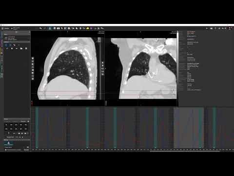 Analyzing a 4D CT Part 1 Setting up a 4DCT in MIM