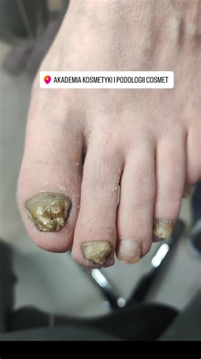 Niestety błędna diagnoza oraz niewłaściwie prowadzona kuracja doprowadziły do obecnego stanu płytki paznokciowej. Wykonanie badania mykologicznego i wdrożenie odpowiednio dobranej terapii może przynieść znakomite efekty. Zapraszamy do Akademii Kosmetyki i Podologii Cosmet w Mińsku Mazowieckim a pomożemy zrealizować te efekty☺️. #podologia #paznokcie #grzybicapaznokci #grzybicastóp #grzybica