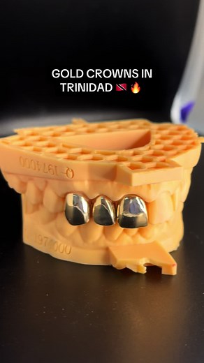 Transform Your Smile with Gold Teeth in Trinidad