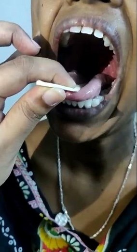 Normal uvula