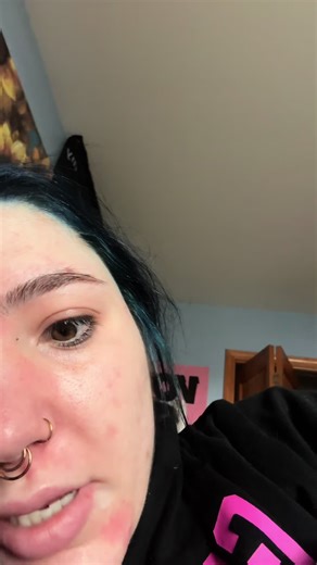 someone HELP ME | pink eye