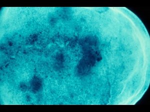 Myeloma - Pathology mini tutorial