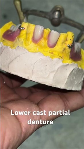 Lower cast partial denture 😬😬😬#splittooth #apexdental #dentistry #partialdenture #orthodontist