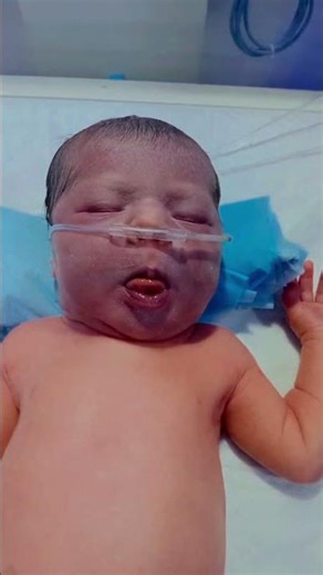 NICU Newborn Baby Cyanosis | What Does Blue Skin Mean in Babies? #naturalbirthing #newborn