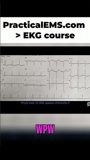 EKG Interpretation: Identifying Ischemia and Infarction (Step-by-Step)
