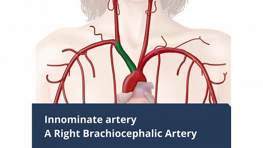 Innominate Artery- A Right Brachiocephalic Artery - Daily Medicos