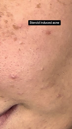 Nadixa for Acne Scar Treatment