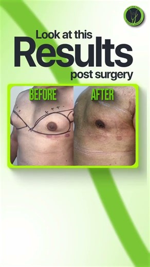 10 Years of Gynecomastia Fixed in 2 Days 💪