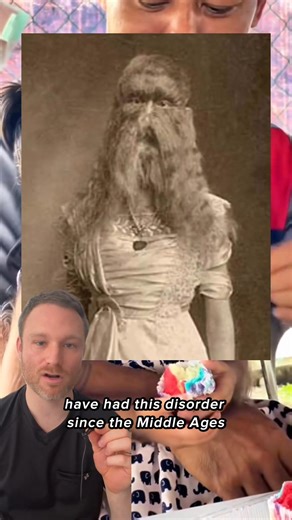 Only around 50 true cases of hypertrichosis lanuginosa have ever been recorded since the Middle Ages — a condition where hair begins to grow all over the body. Some historians even believe this rare disorder inspired the original Beauty and the Beast tale. | Taylor Bullock, MD