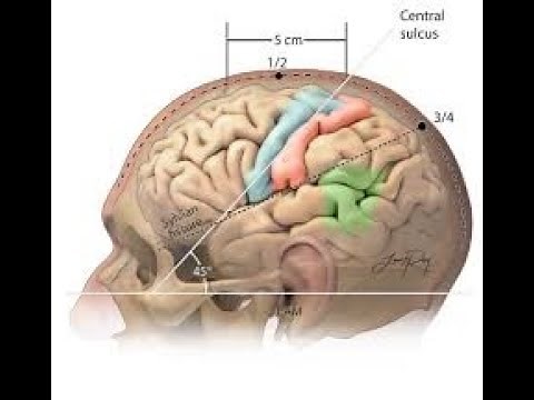 Craniectomy with foreign body removal from brain CPT code - simplify medical coding