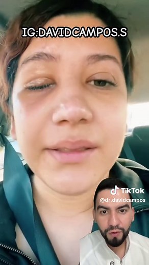 Causas y tratamientos de lagañas en los ojos