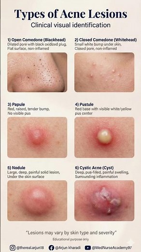Types of Acne Lesions Explained | Blackheads, Whiteheads, Papules, Nodules & Cystic Acne #acnes