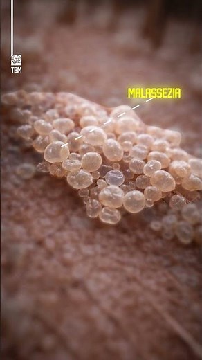 The Biology of Dandruff