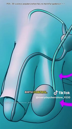 Understanding the Vasectomy Birth Control Procedure