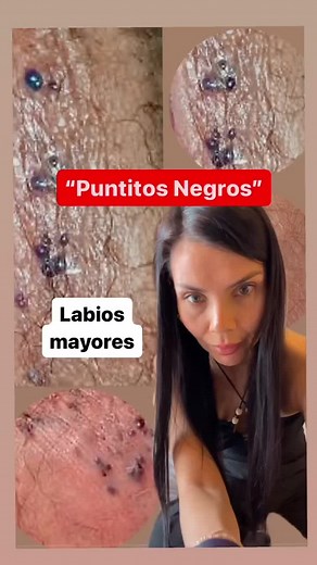 Que son los puntitos negros en la vulva