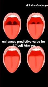 #mpc ##airway #mallampati classification #modified mallampati classification #aiway assessment