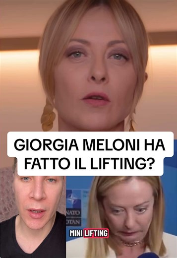 Giorgia Meloni continua a far parlare di sé. Questa volta anche per il suo viso, che appare decisamente ringiovanito e fresco. Farà ricorsa alla medicina estetica e alla chirurgia plastica? Si era già parlato di possibili trattamenti viso, come botox o filler, ma questa volta qualcuno parla di mini lifting. Ho già parlato di come alcuni personaggi politici ricorrano a questi sistemi per ritrovare giovinezza e bellezza ed apparire così più rassicuranti. Sarà questo il caso? Tu cosa ne pensi? #ski