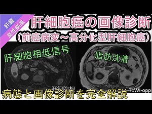 肝細胞癌の画像診断（前癌病変～高分化型肝細胞癌）