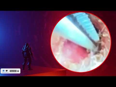 The Truth About earwax Will Shock You. How to remove earwax from ear, earwax extractions