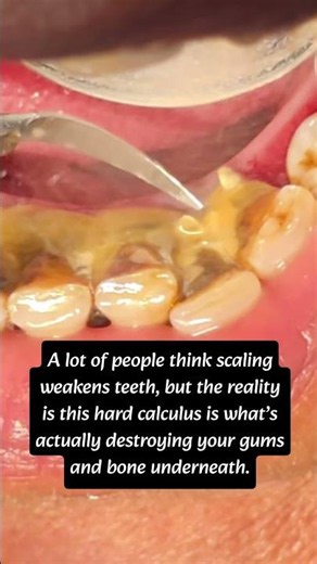tartar Removal// calculus Removal// teeth cleaning #drpriyankakatewa #jaipurdentist #dentalclinic