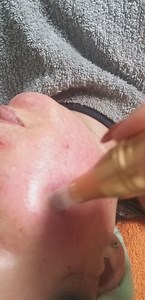 Microneedling anti traces d'acné 2 ème séance 🥰🥰🥰🥰 | Naturel pour elle