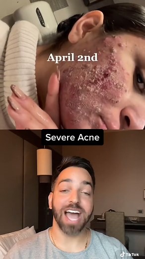 87K views · 665 reactions | AMAZING glow up #dermdoctor #acnetreatment #accutane | Doctorly | Facebook
