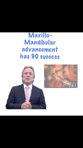 Dr. Cesar A Guerrero | OBSTRUCTIVE SLEEP APNEA is increasing secondary to weight increase and sedentary life style. MAXILLO-MANDIBULAR ADVANCEMENT (MMA) is the... | Instagram