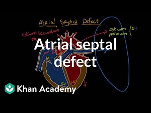 Atrial Septal Defect - Medical Video Lecture - MBBS