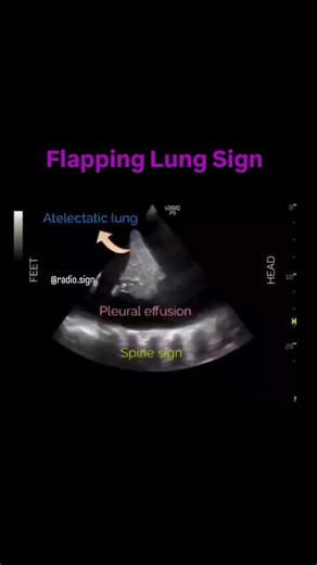 The Flapping Lung Sign, also known as the Jellyfish Sign, is a dynamic sonographic marker of compressive atelectasis in the setting of moderate to large pleural effusion. On B-mode ultrasound, the compressed, non-aerated lung appears as a mobile, echogenic, lobulated tissue mass surrounded by anechoic pleural fluid. With each respiratory cycle, this atelectatic lung moves pendulously, “flapping’’ inward and outward, resembling the rhythmic motion of a jellyfish swimming within the fluid collecti