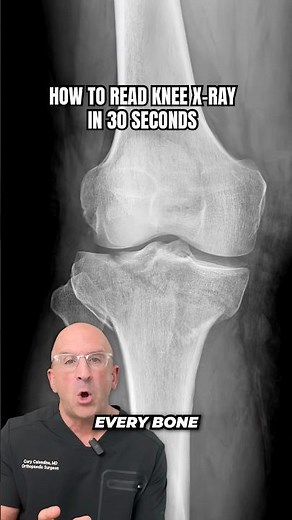 How to Read Knee X-Rays Like a Surgeon⁉️