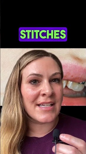 BLEEDING LIP? Does It Need STITCHES? (How to tell)