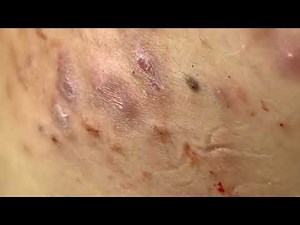 狂擠粉刺 | 療癒系猛擠黑頭粉刺6，紓壓快感，隨便擠，任我擠，擠擠擠！祝您身心愉悅！