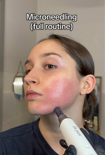 Microneedling Step-by-Step Full Routine for Acne Scars