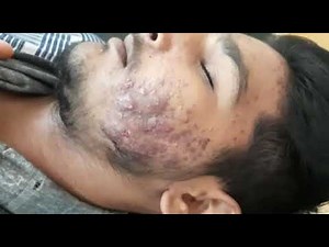 Cystic Acne Vulgaris on Face (Dr Bhutada Skin India clinic)