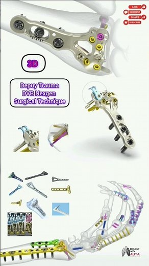 Depuy Trauma - DVR Nexgen Surgical Technique #3d #shorts
